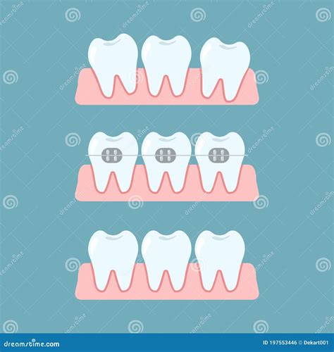 Illustrazione delle fasi del trattamento ortodontico