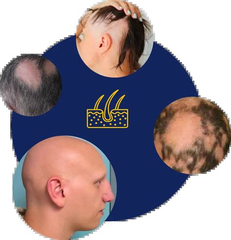 Meccanismi alopecia