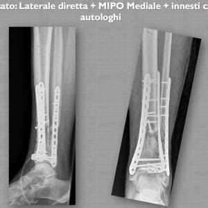 Radiografia di una frattura complessa di tibia trattata con fissatore esterno