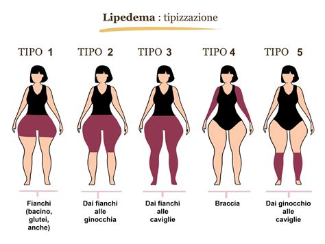 Immagine esplicativa del lipedema sulle gambe