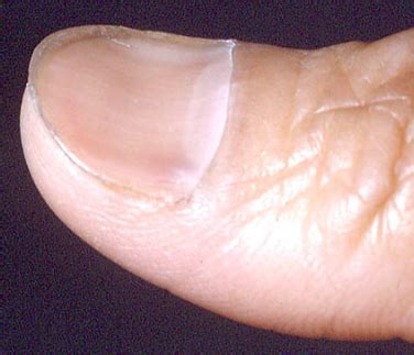 Unghia a cucchiaio (coilonichia) in caso di anemia sideropenica