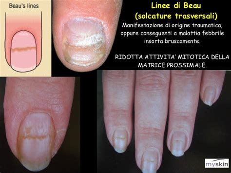 Linee di Beau causate da chemioterapia