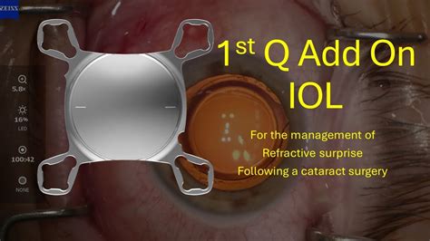 Schema di una IOL Add-on