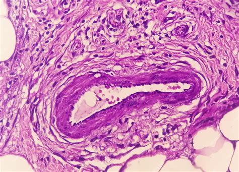 Microfotografia di un granuloma sarcoideo non caseoso