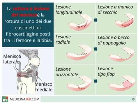 lesione traumatica e degenerativa del menisco