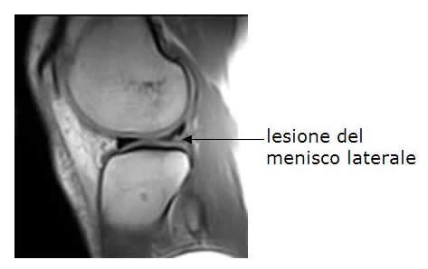 Risonanza Magnetica del ginocchio con evidenza di lesione meniscale