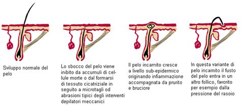 Schema della prevenzione dei peli incarniti