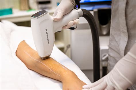 Tecnologia dell'epilazione laser