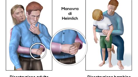 Illustrazione manovra di Heimlich per bambini