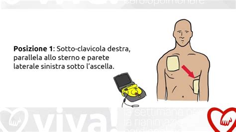 Posizionamento piastre DAE pediatrico