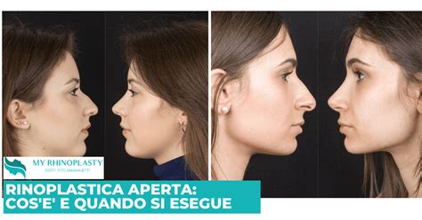 Tipi di rinoplastica (aperta vs. chiusa)