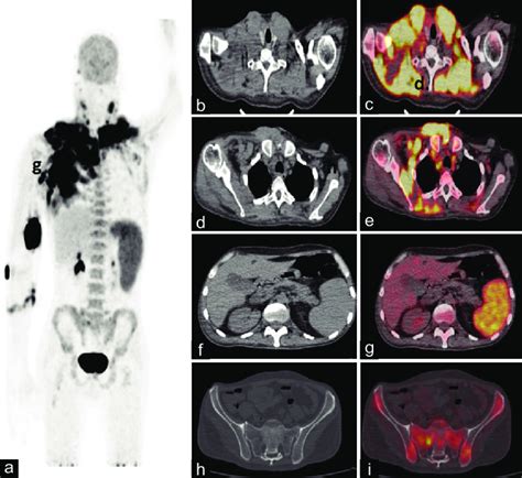 PET-CT scan image showing areas of increased FDG uptake