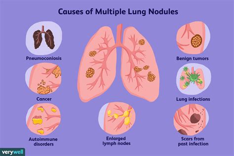 Diagram illustrating different types of solitary pulmonary nodules
