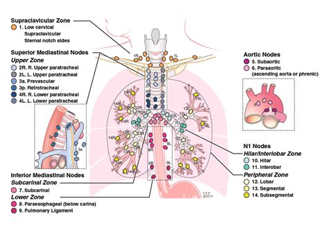 Image illustrating metastatic lymph nodes in the mediastinum