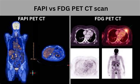 Infographic comparing FDG-PET and FAPI-PET