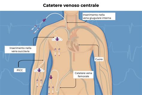 Schema che illustra le diverse tipologie di cateteri venosi centrali (monolume, multilume, PICC, Port-a-Cath)