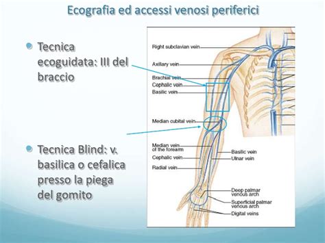 Immagine che mostra il posizionamento di un PICC dall'arto superiore al torace