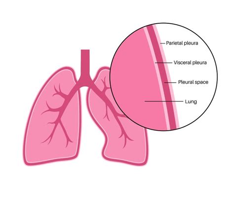 rappresentazione anatomica della pleura e dell'effetto delle fibre di amianto
