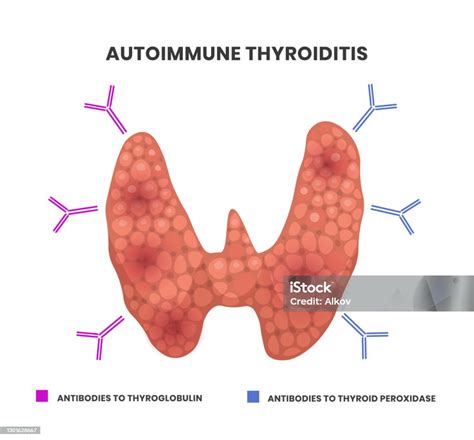 Immunoglobuline che attaccano la tiroide