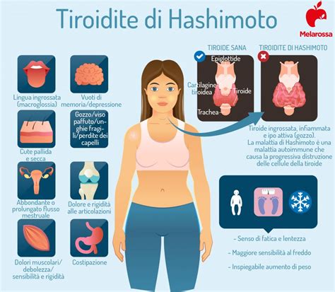 Schema della tiroidite di Hashimoto