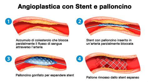 Schema di angioplastica con stent