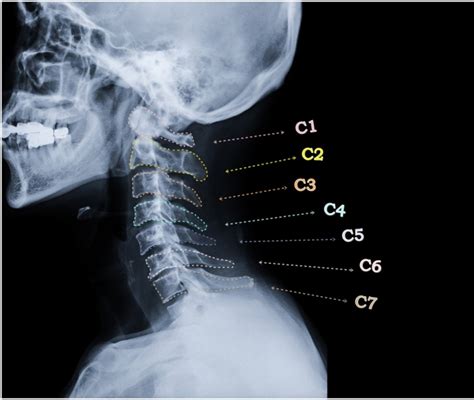Diagramma della colonna vertebrale cervicale e compressione nervosa