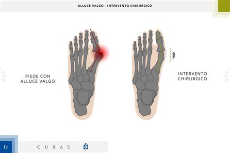 Confronto tra tecniche chirurgiche per l'alluce valgo