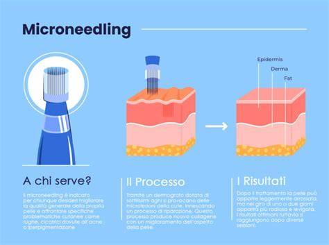 infografica che illustra il processo di microneedling