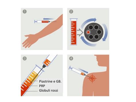 infografica che spiega il processo di preparazione del PRP