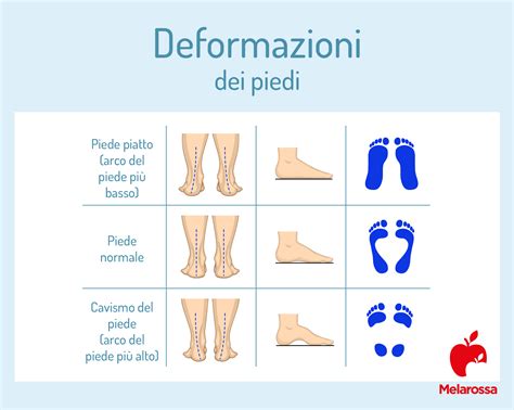 Piede pronatore e usura scarpa interna