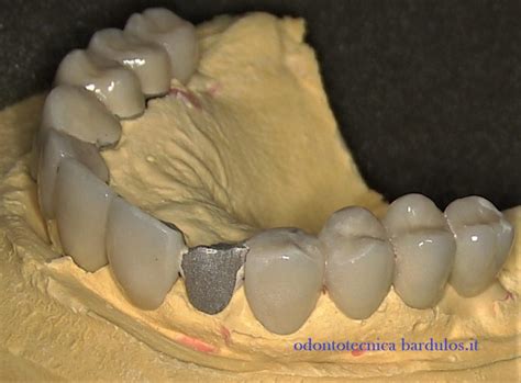 Schema delle cause di frattura ceramica nelle protesi fisse