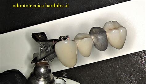 Esempio di scheggiatura ceramica con esposizione del metallo