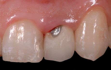 Applicazione incrementale del composito in resina per la riparazione intraorale
