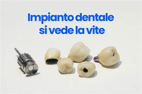 Cambio di tragitto protesico grazie all’utilizzo del cacciavite e della vite cardanica