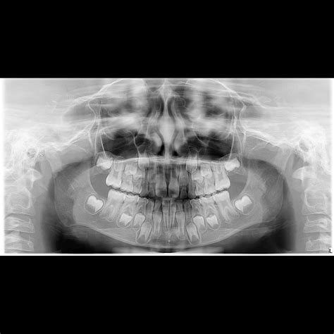 Radiografia panoramica iniziale