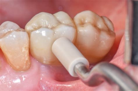 Attivazione degli abutment con percussore e applicazione delle cappette
