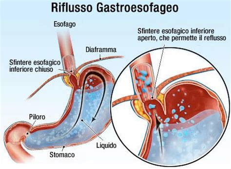 Reflusso gastroesofageo e vie respiratorie