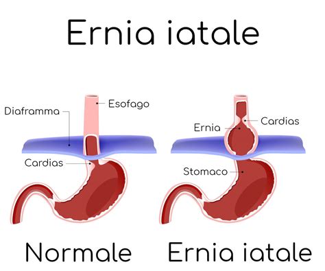 Sintomi ernia iatale