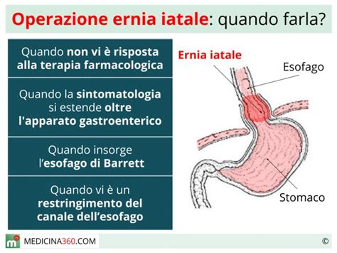 Intervento chirurgico ernia iatale