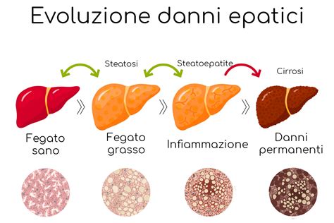 infografica sulle fasi di evoluzione della steatosi epatica