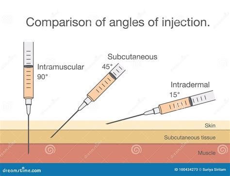 Diagramma dei diversi angoli di iniezione per via intramuscolare, sottocutanea, intradermica e endovenosa
