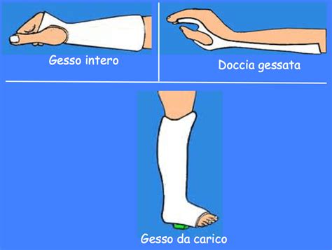 Gesso ortopedico sull'arto inferiore