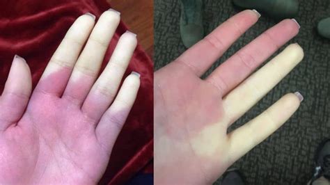 mani pallide e bluastre a causa del fenomeno di Raynaud