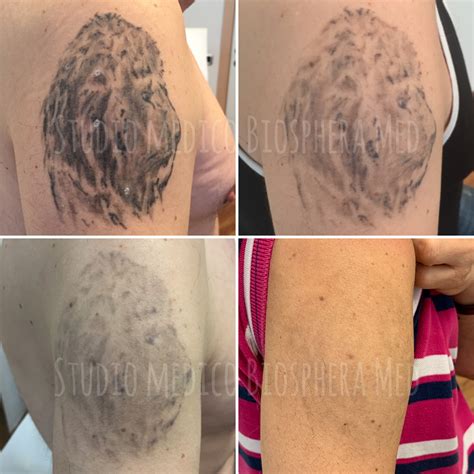 Rimozione tatuaggi laser