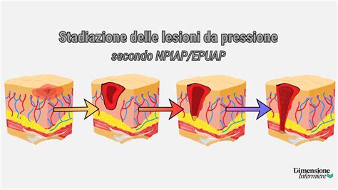 Diagramma che mostra la riduzione delle lesioni grazie all'airbag e alle cinture