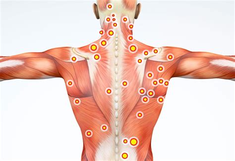 Illustrazione di un trigger point miofasciale nella muscolatura della schiena