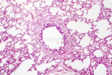 Tessuto polmonare normale e amartoma polmonare a confronto