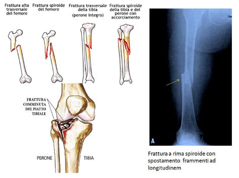 Radiografia di una frattura sternale