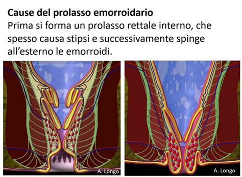 Differenza tra emorroidi sane e emorroidi infiammate