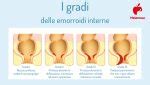 Classificazione dei gradi delle emorroidi interne ed esterne